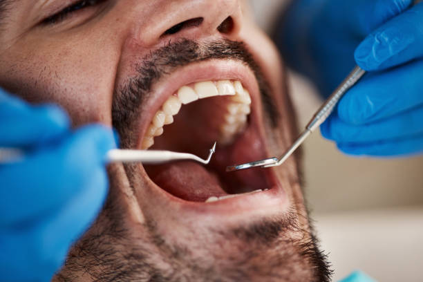 Best Emergency Dentist for Lost Fillings or Crowns in Nanuet, NY